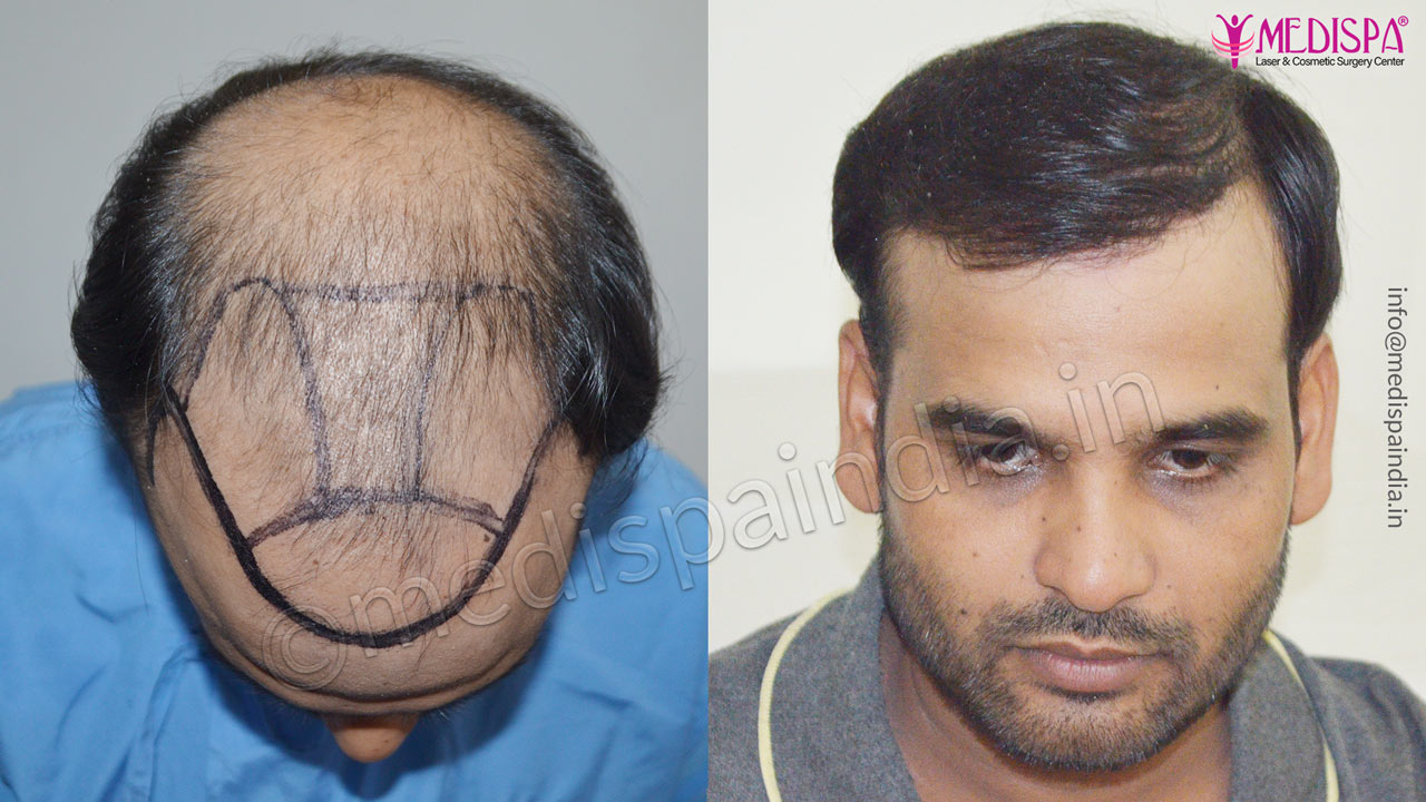 Hair Transplant in Kerala Best Cost Expert Surgeon