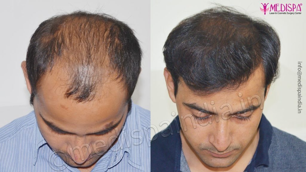 Best Hair Restoration Results In Jaipur Hair Transplant In Delhi Hair