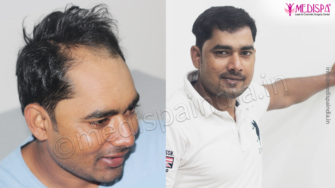 hair transplant clinic results Hyderabad