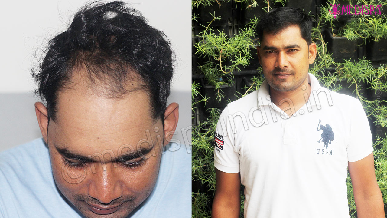 hair transplant clinics results delhi