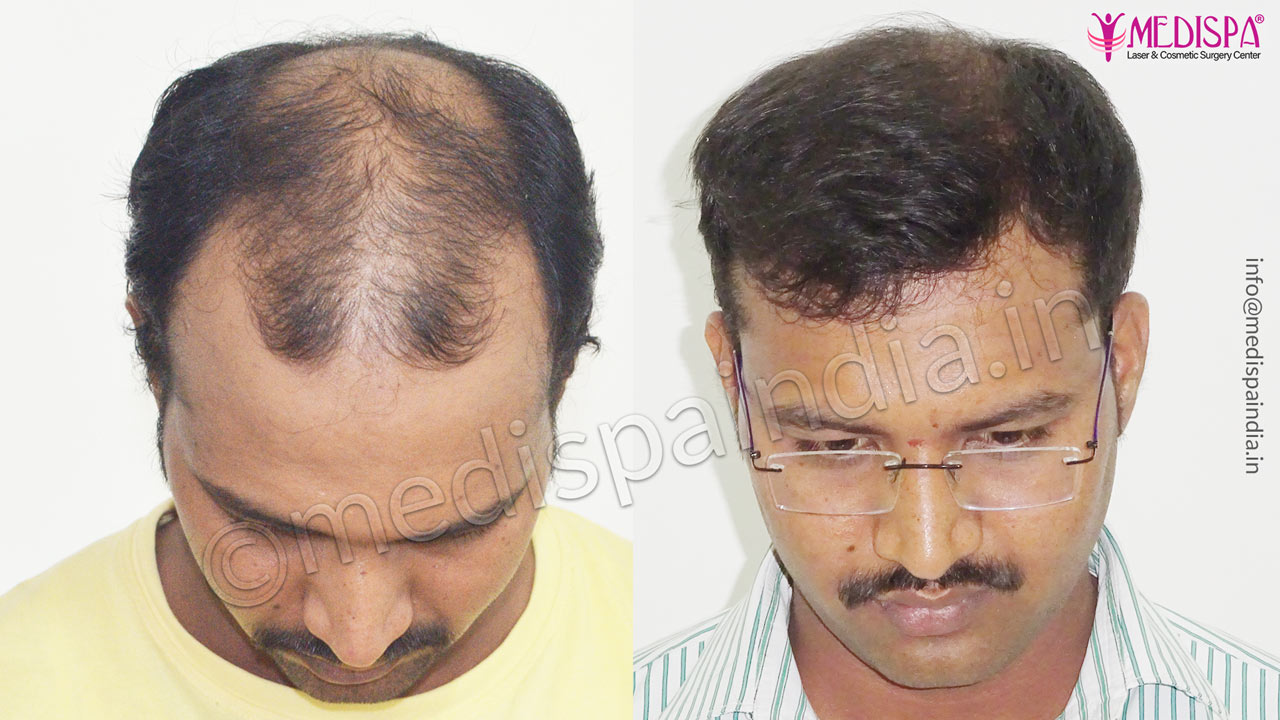 DHI IndiaHair Transplant and Hair Restoration Clinic in Lavelle Road Bangalore  Book Appointment Online  Best Hair Transplant Doctors in  Bangalore  Justdial