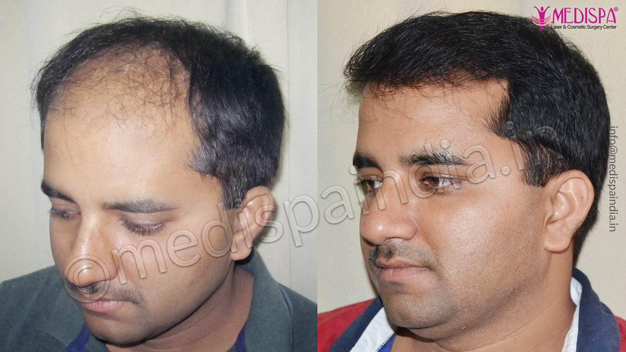 Hair Transplant Before After Jaipur Rajasthan Hair Transplant in Delhi | Hair  Transplant Cost in Delhi Clinic