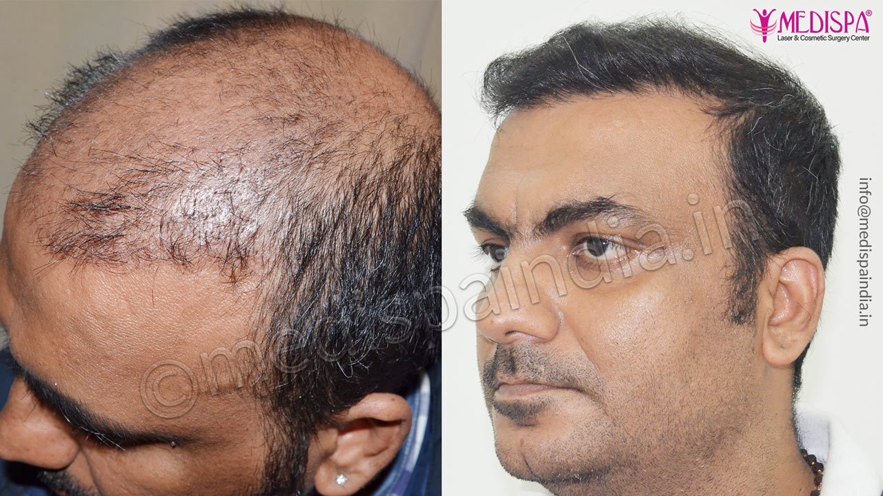 Corrective Hair Transplants Result India Hair Transplant in Delhi | Hair  Transplant Cost in Delhi Clinic