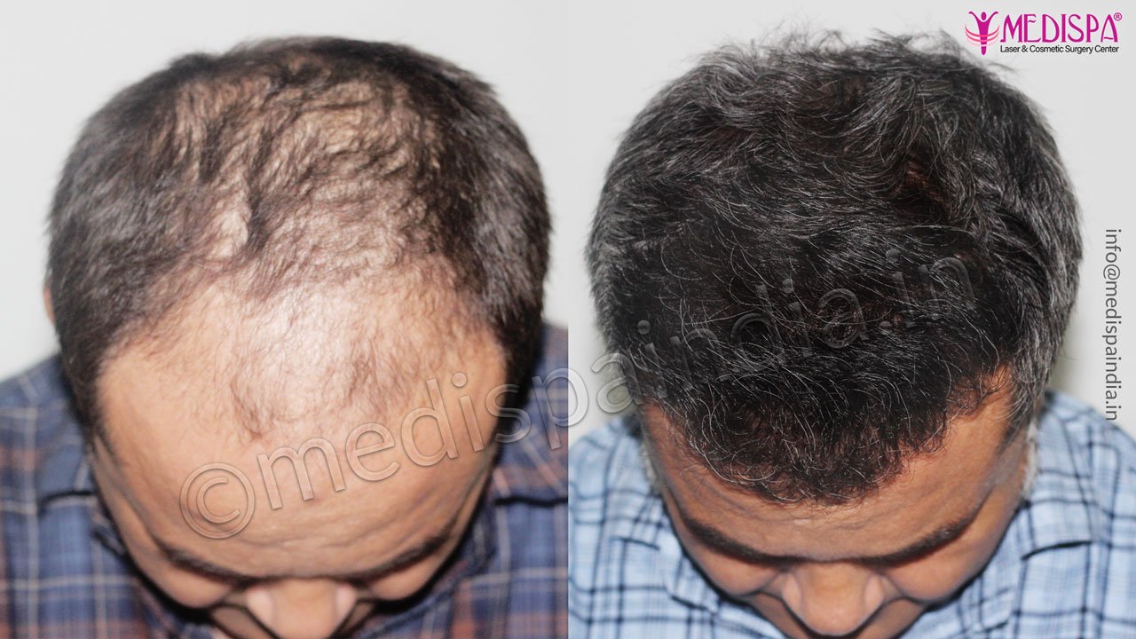 hair transplant saudi arab results