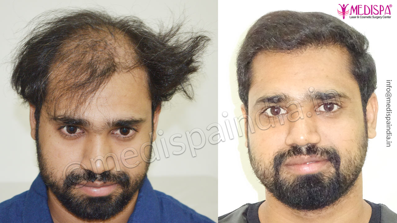 Best Hair Transplant in Mumbai  Hair Lose Treatment  Enhance Clinic