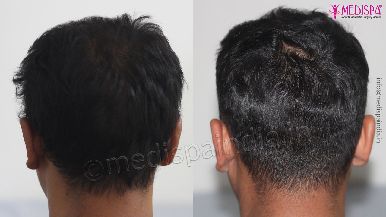 hair transplant results jaipur