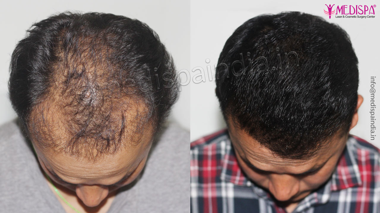 hair transplant results udaipur