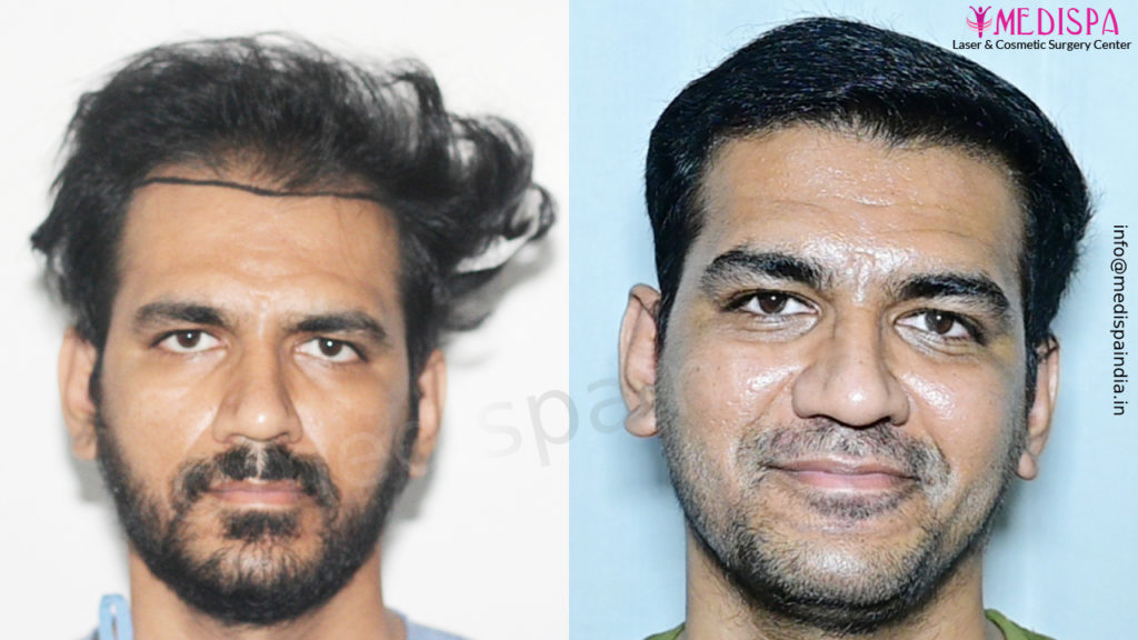 hair transplant