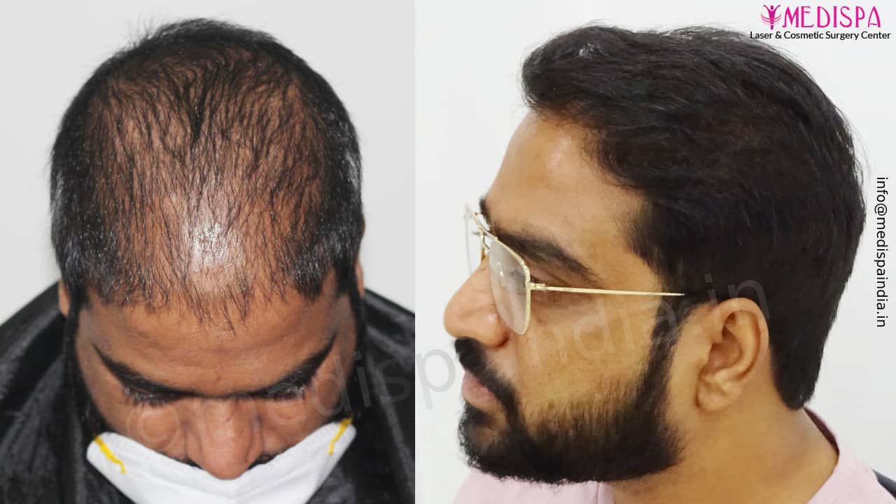 hair transplant cost in bangalore