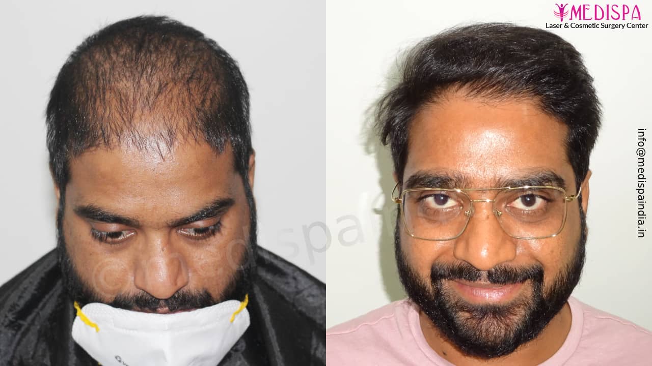 hair transplant cost in delhi