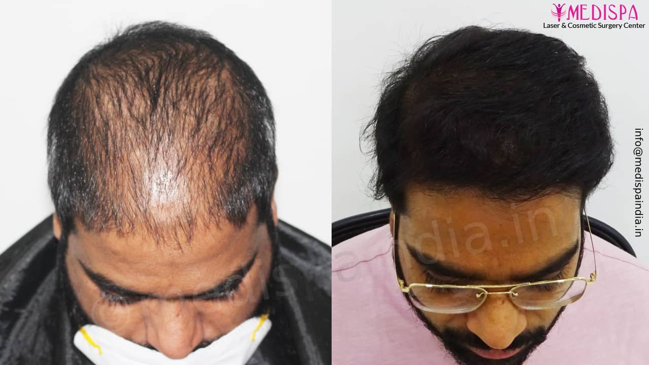 hair transplant cost in mumbai