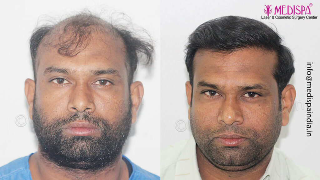 hair-transplant-results-India