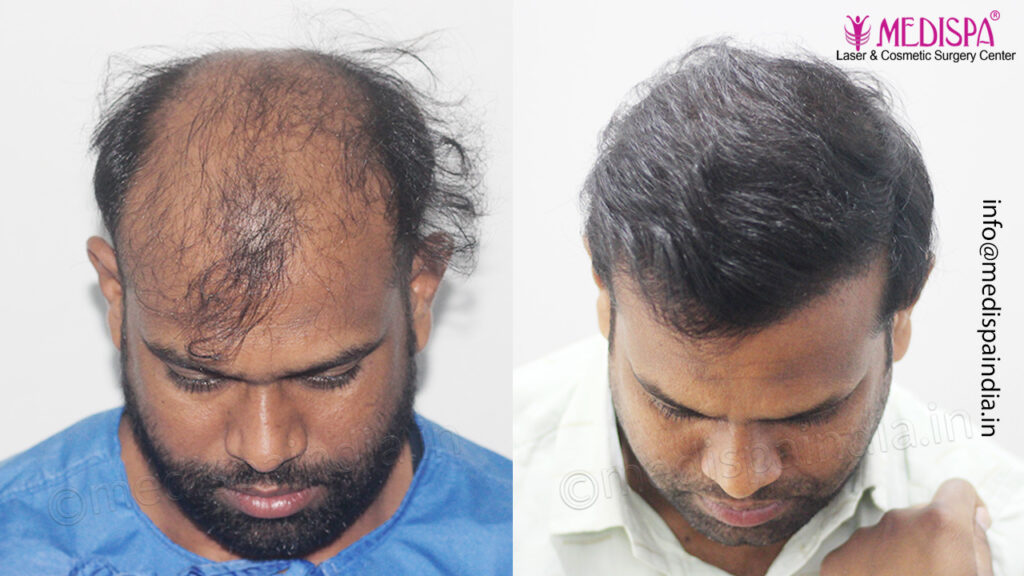 hair-transplant-results-delhi