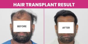 Is It Safe To Get A Hair Transplant? Precautionary Measures & Safety Tips