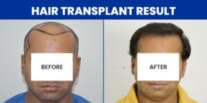 How To Find The Best Hair Transplant Surgeon?