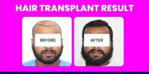 How To Find The Number Of Grafts Required For Hair Transplant?