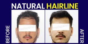 All You Need To Know About Hair Transplant Success Rate