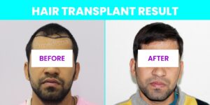 Why is Donor Area important for the Hair Transplant?