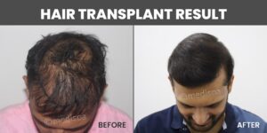 How To Decide Which Hair Transplant Method Is Suitable For You?