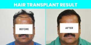 How To Speed Up Your Hair Growth After Hair Restoration