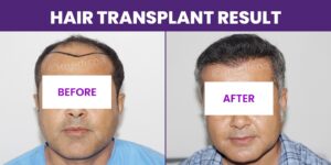 A Checklist To Hair Transplant: Things You Should Ask Your Surgeon