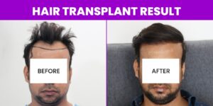 Is Hair Transplant The Best Way To Cure Pattern Baldness?