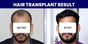Explain The Success Rate Of Hair Transplant Procedure