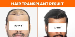 Is Hair Transplant Better Than Medication?