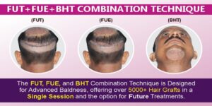 Is FUT+FUE+BHT Hair Transplant Method Effective For Hair Loss?