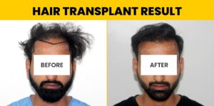 How To Achieve Natural Hairline By Hair Restoration?