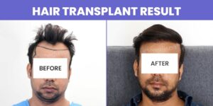 Why Consider Hair Transplant When You Are Dealing With Hair Loss?