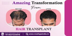 Do The Skills of The Surgeon Affect The Results of Hair Transplant?
