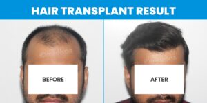 Explain The Attributes Of A Hair Transplant Surgeon