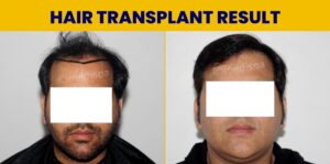 Is Hair Restoration The Best Solution For Genetic Baldness?