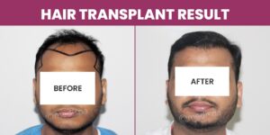 Can Hair Transplant Surgery Provide Natural Hair Growth?