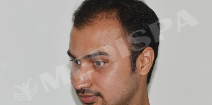 fut-hair-transplant