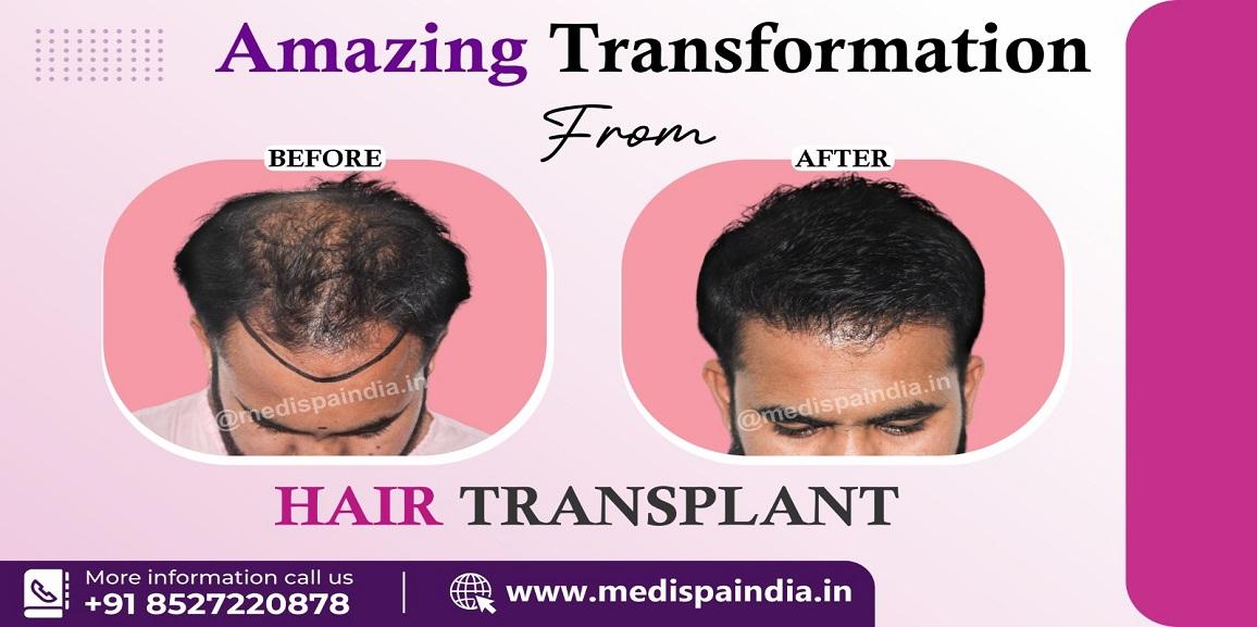 Do The Skills of The Surgeon Affect The Results of Hair Transplant?