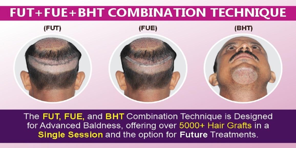Is FUT+FUE+BHT Hair Transplant Method Effective For Hair Loss?