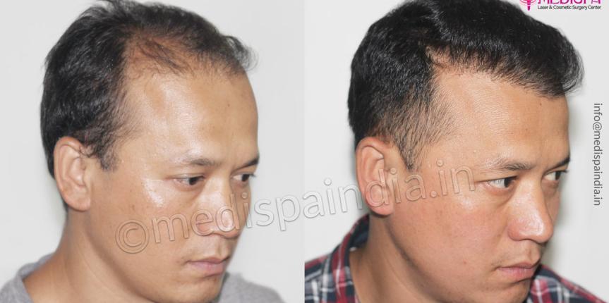 hair transplant results bikaner