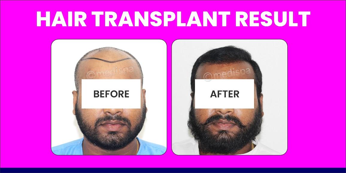 How To Find The Number Of Grafts Required For Hair Transplant?