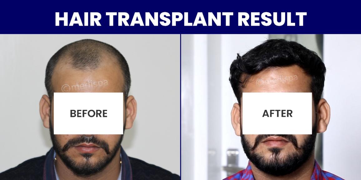 Factors To Be Considered Before Undergoing Hair Transplantation