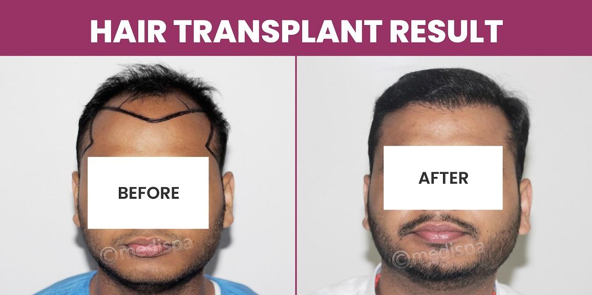Can Hair Transplant Surgery Provide Natural Hair Growth?