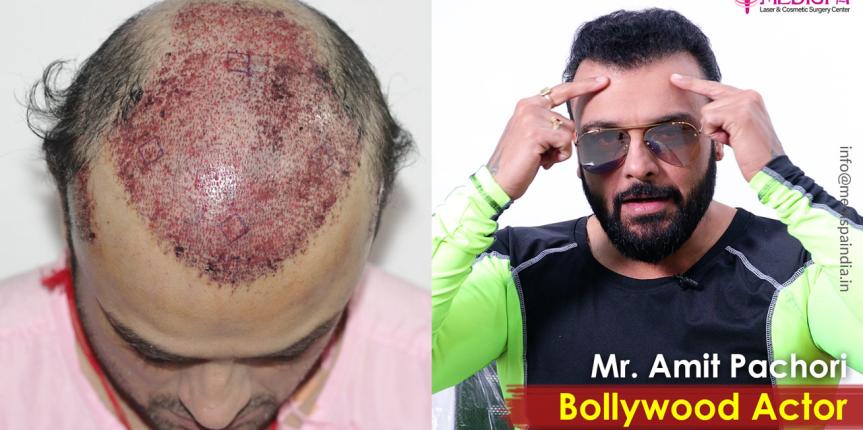 celebrity hair transplant rajasthan