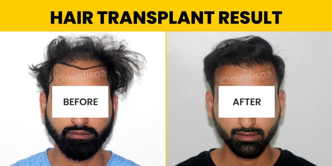 How To Achieve Natural Hairline By Hair Restoration?
