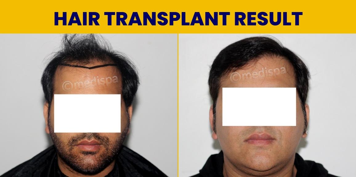 Is Hair Restoration The Best Solution For Genetic Baldness?