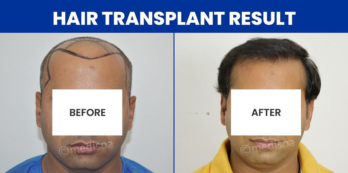 How To Find The Best Hair Transplant Surgeon?