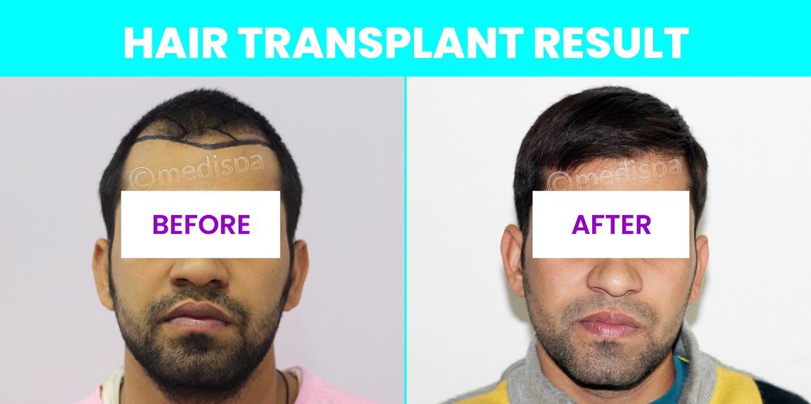 Why is Donor Area important for the Hair Transplant?