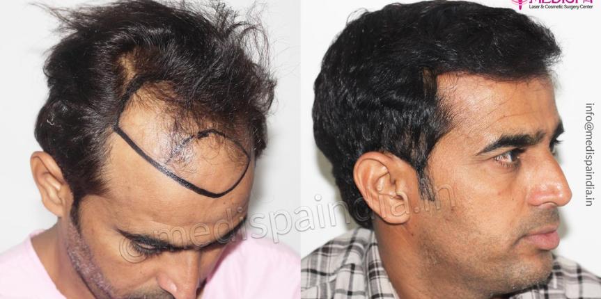 hair transplant cost in jaipur