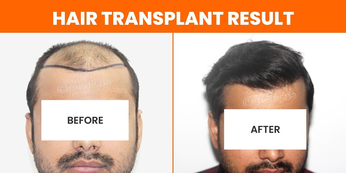 Is Hair Transplant Better Than Medication?