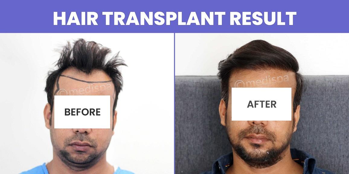 Why Consider Hair Transplant When You Are Dealing With Hair Loss?